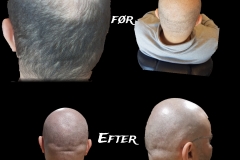 SMP (Scalp Micropigmentation) 