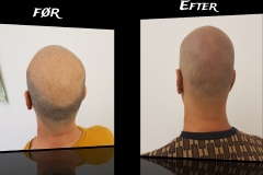SMP (Scalp Micropigmentation) 