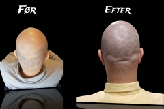 SMP og hårtransplantation: